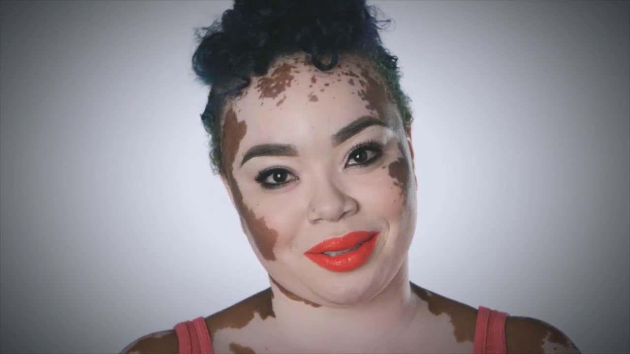 Image result for Vitiligo